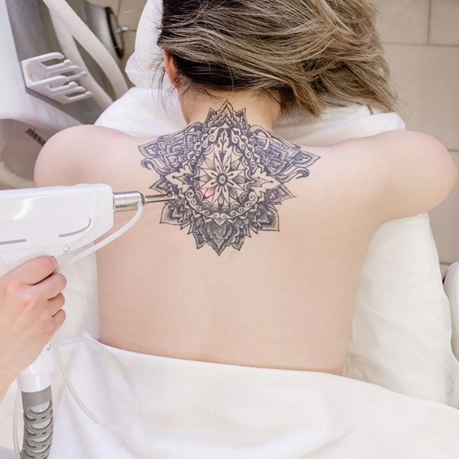 Tattoo Removal