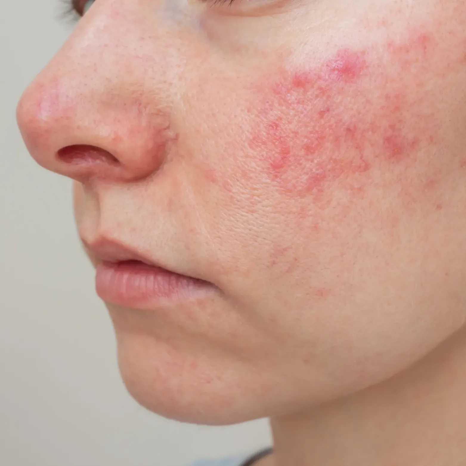 Rosacea Treatment
