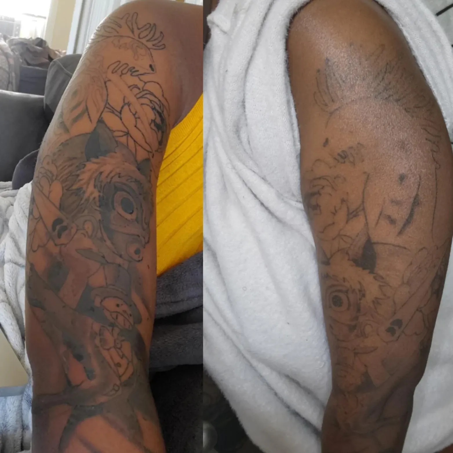 Tattoo Removal / Dark Skin