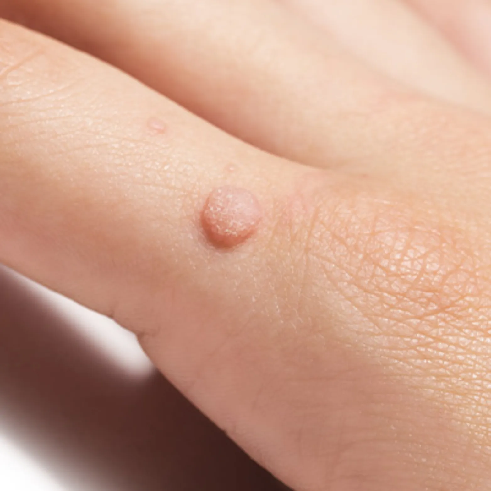 Warts