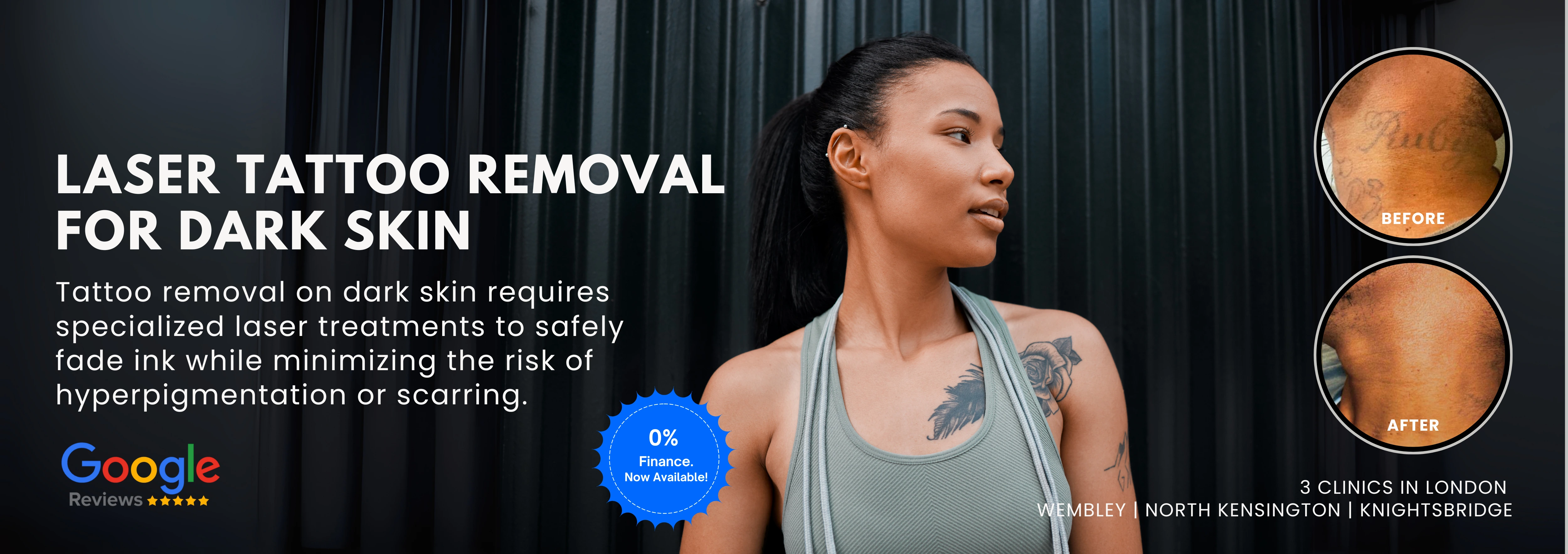 Tattoo Removal / Dark Skin
