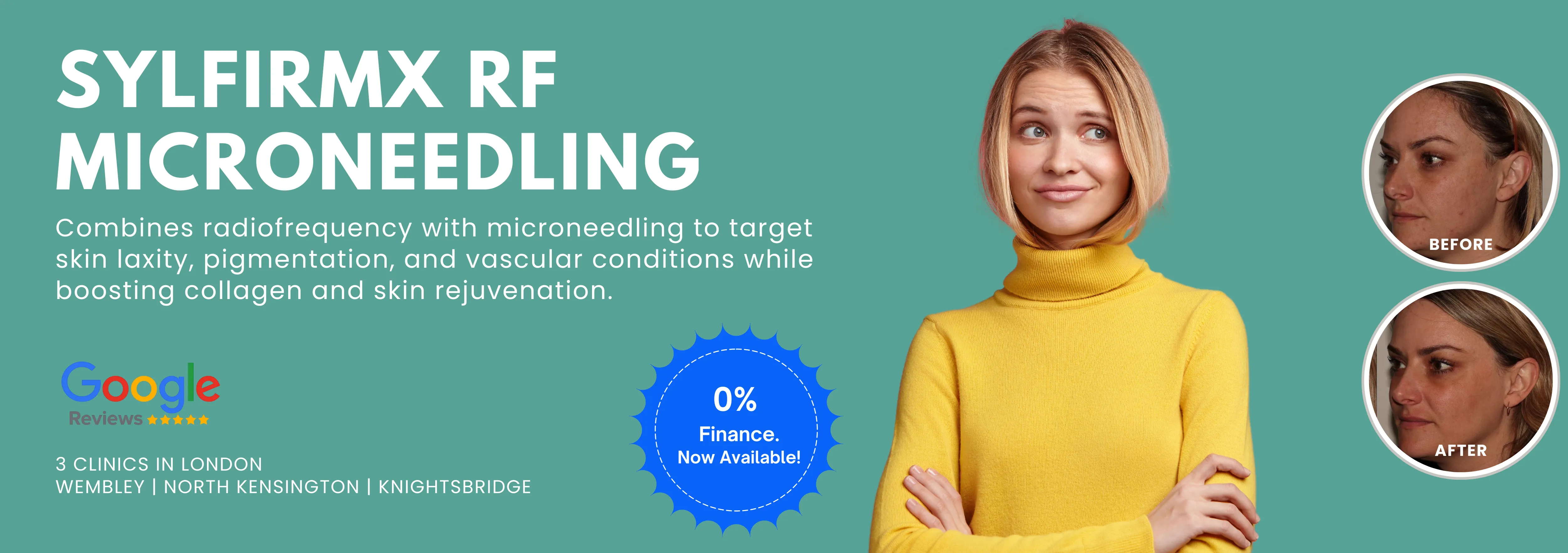 SylfirmX RF Microneedling Treatment