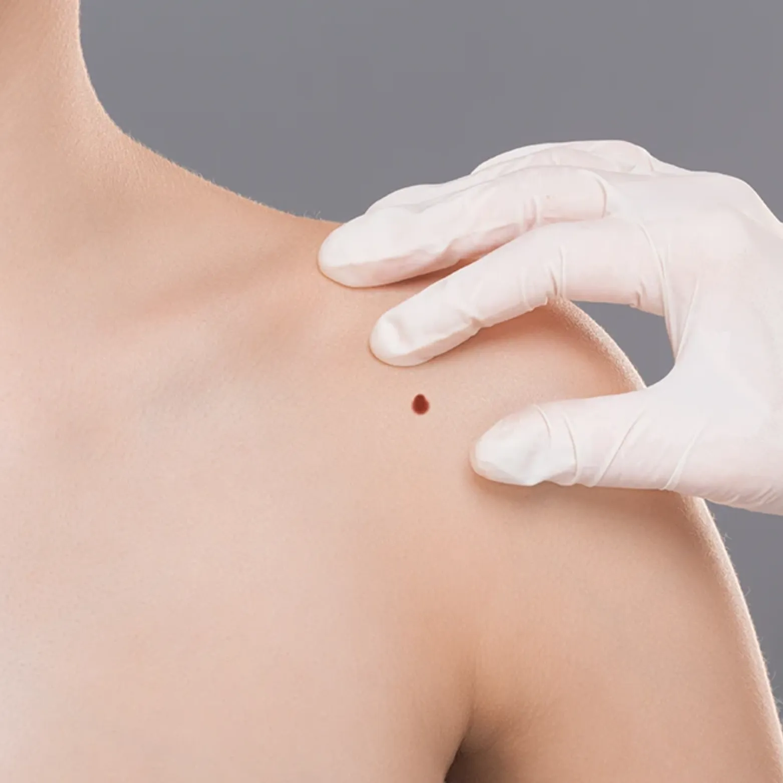 Wart Removal