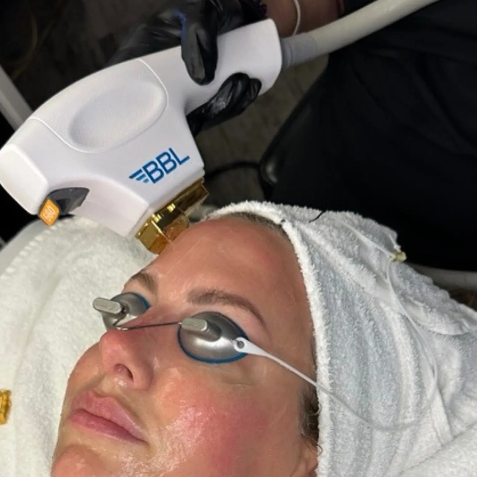 BBL Laser Treatment