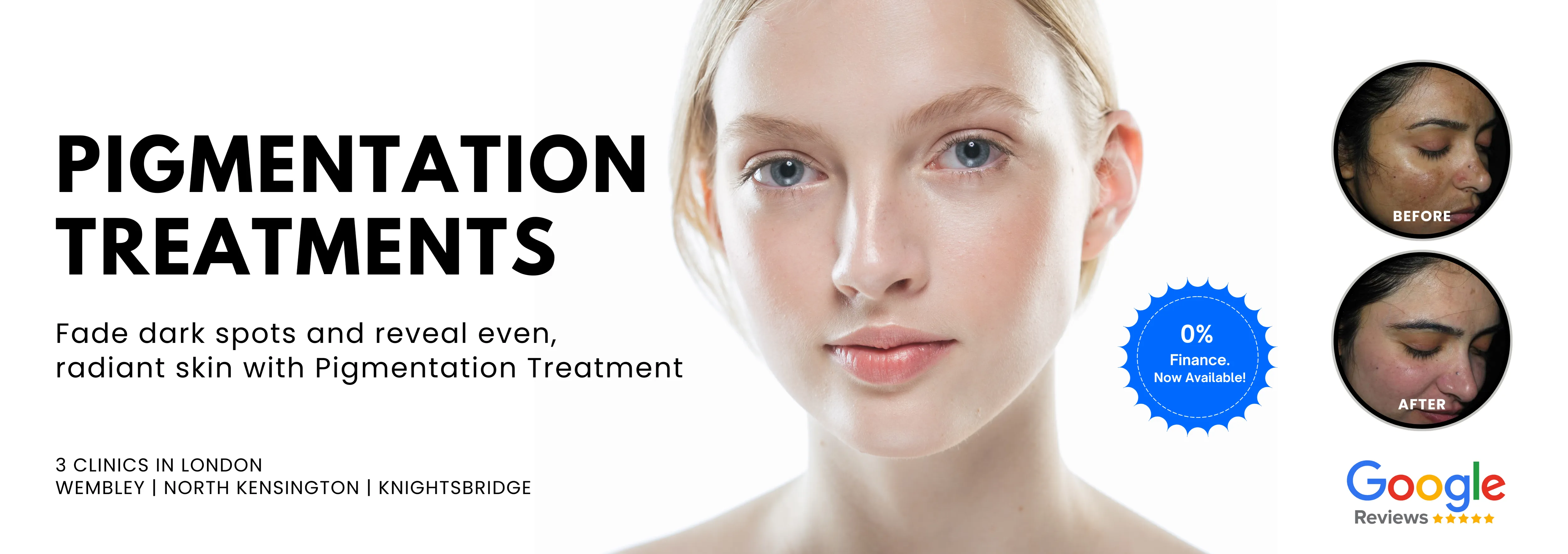 Skin Pigmentation Treatment