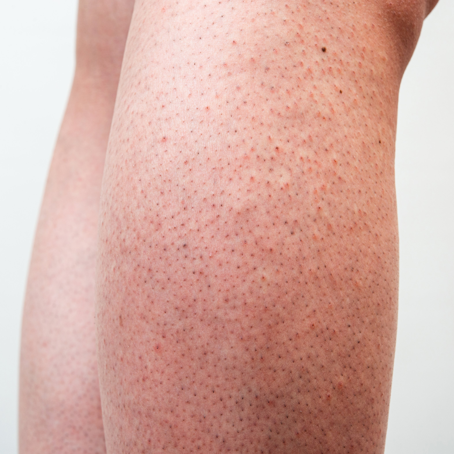 Strawberry Legs