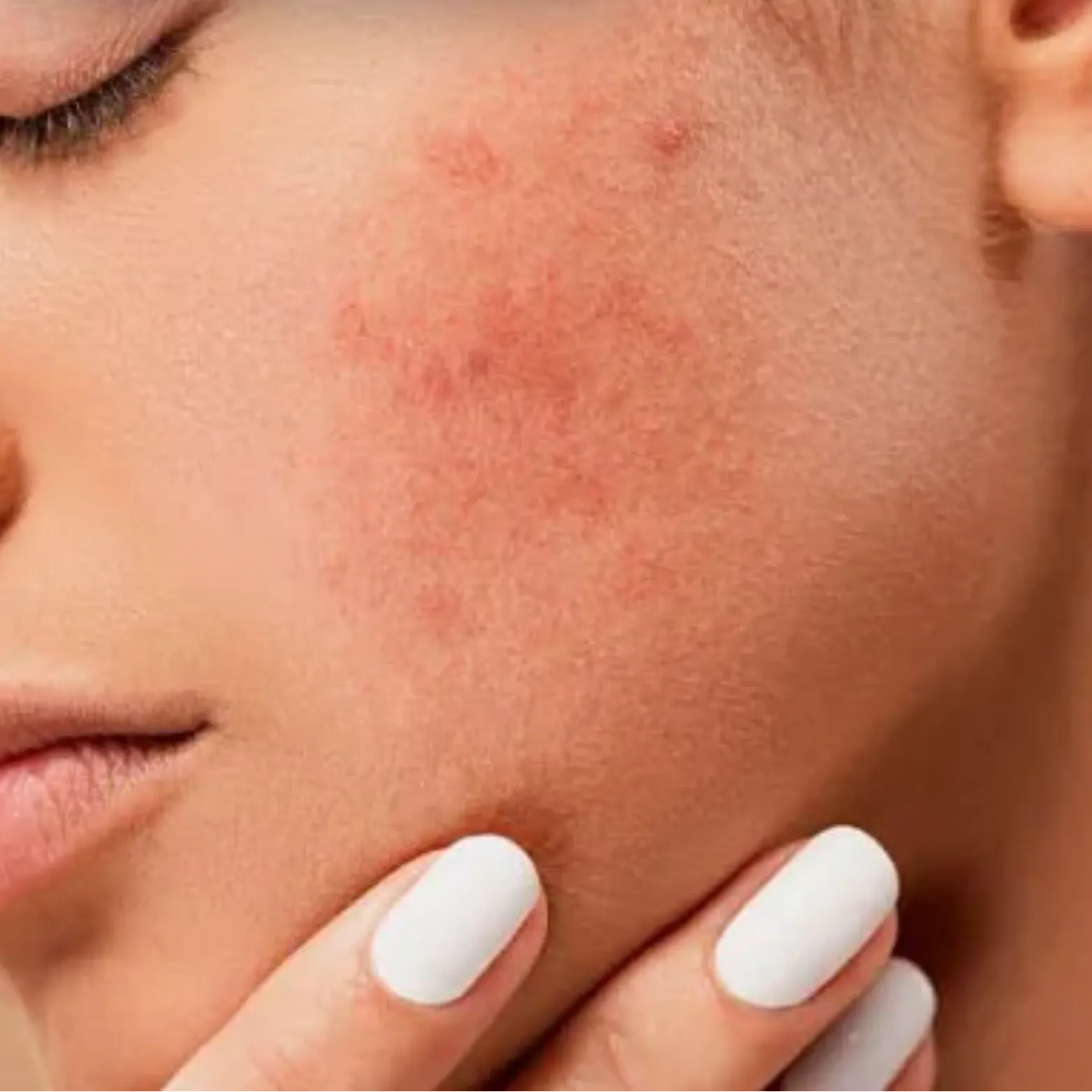Acne Treatment