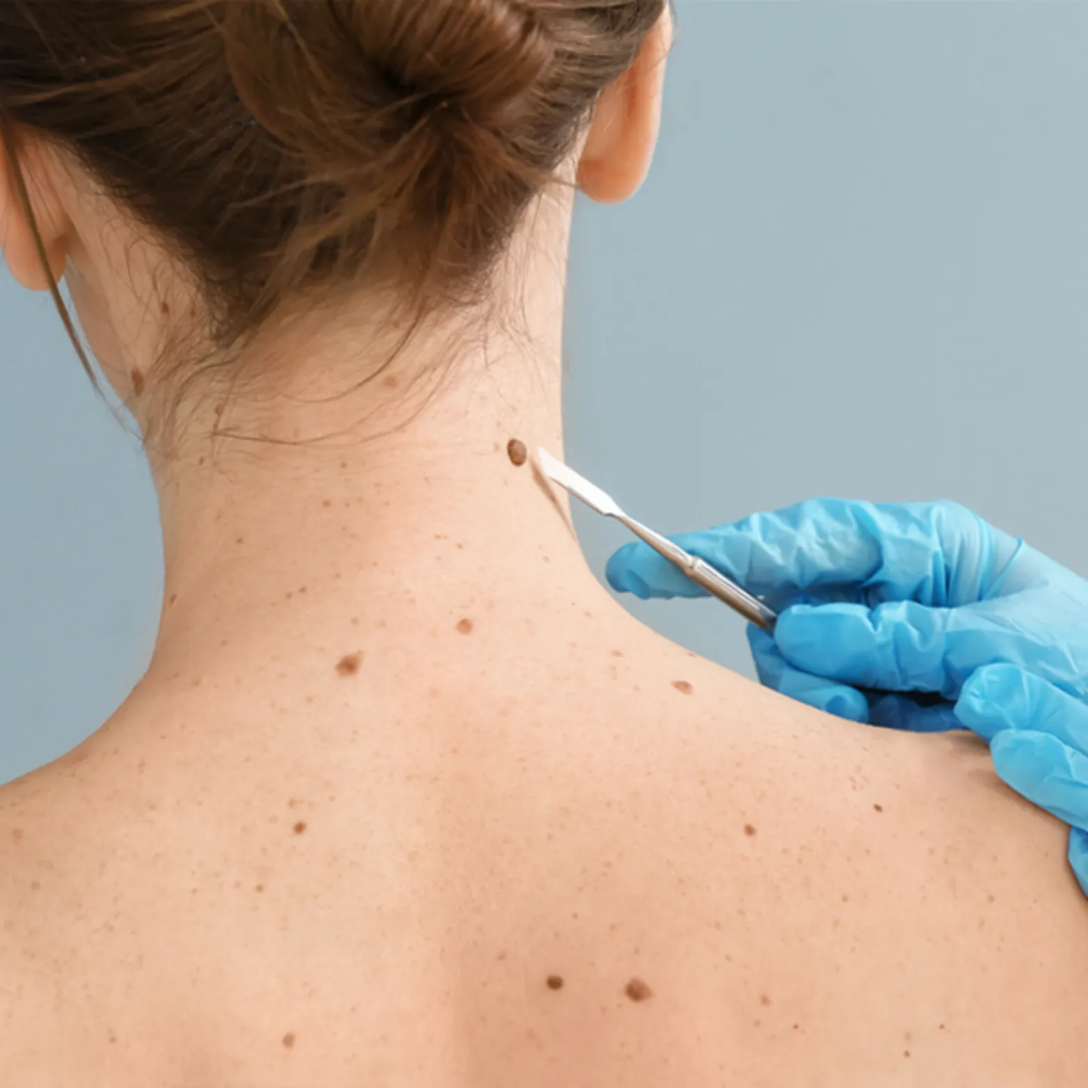Mole Removal