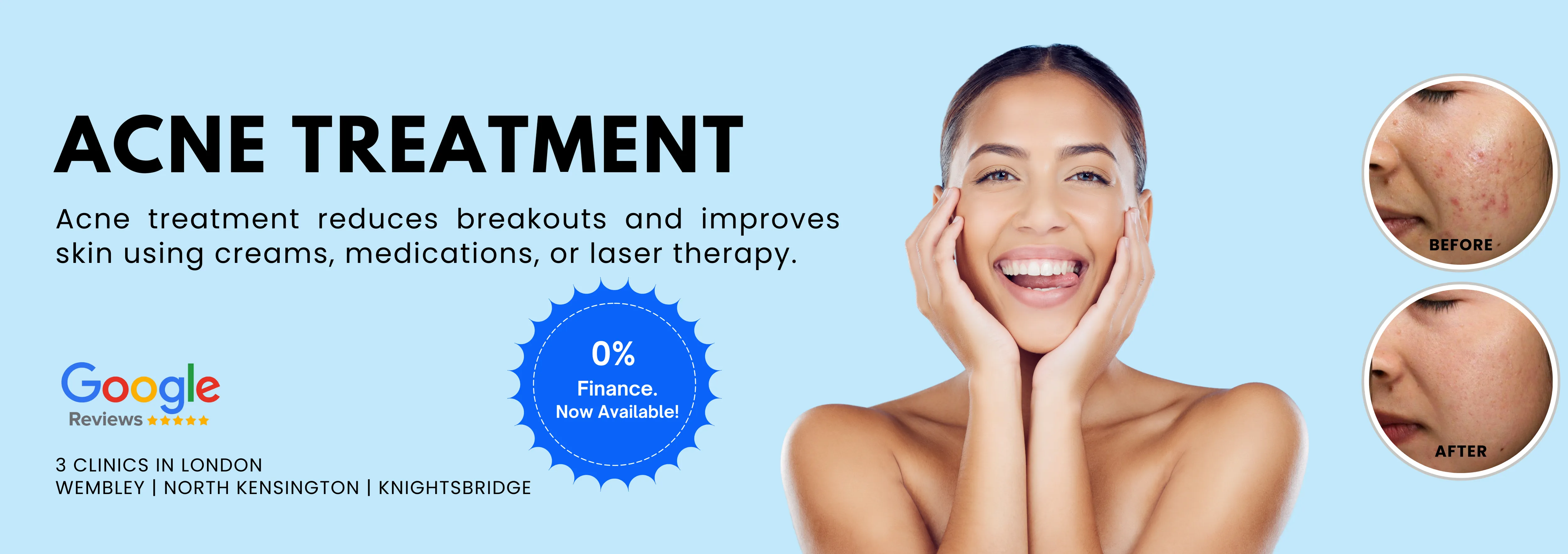 Acne Treatment